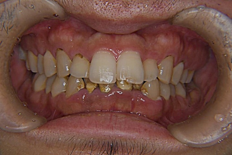 口臭及び歯茎からの出血