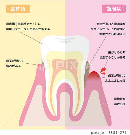 「ただの歯ぐきの腫れと放っておかないで！歯肉炎から歯周病へ進ませないためのセルフケアとプロケア」
